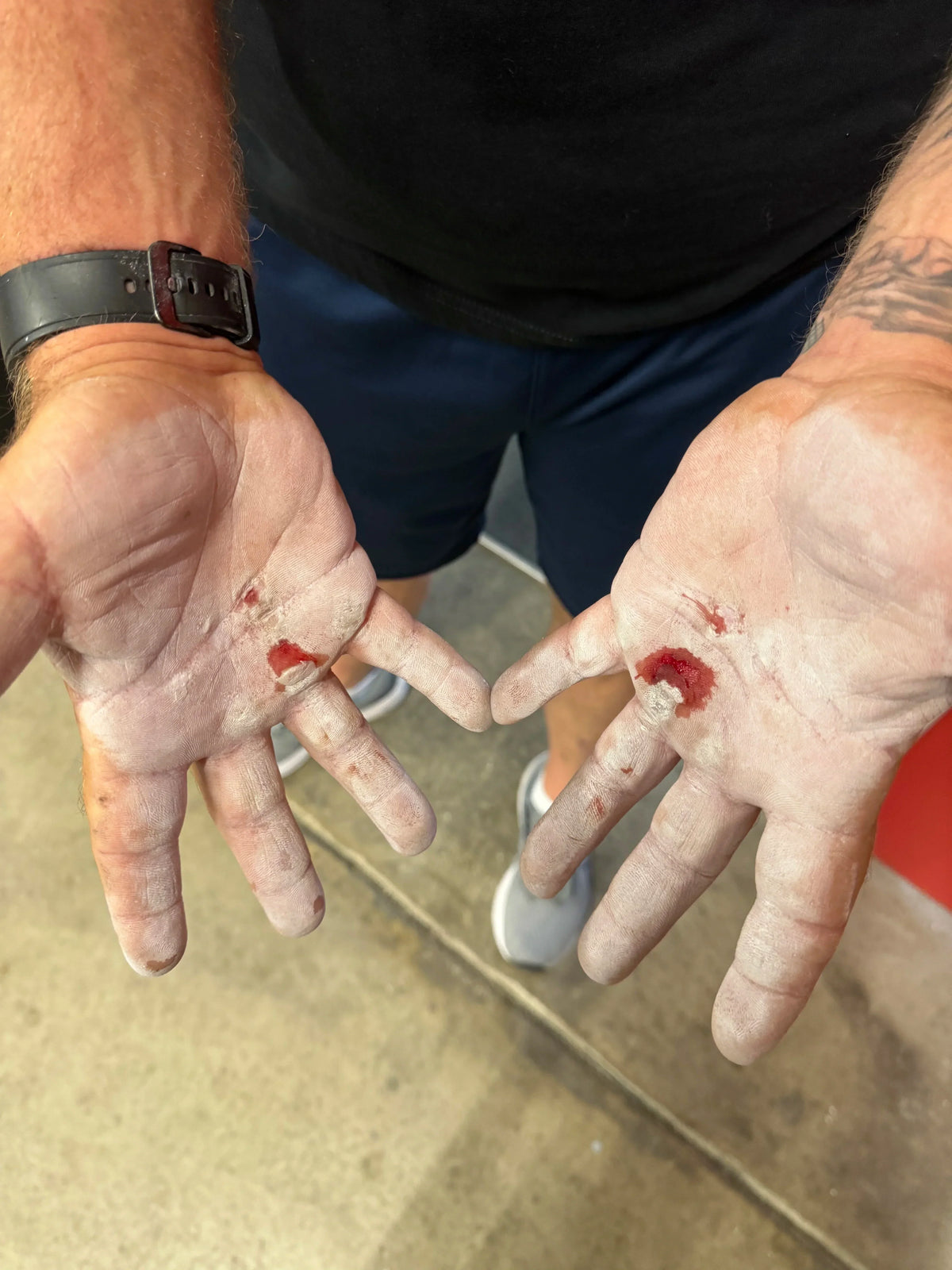How to Choose the Best Callus Care Kit for Grip Athletes