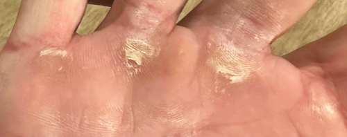 Mastering Callus Care: 3 Indicators Your Calluses Need Attention