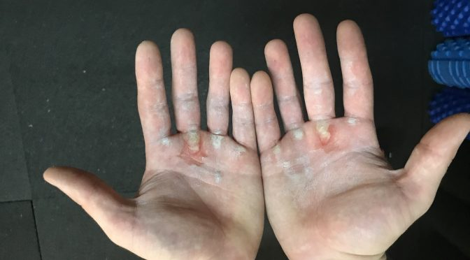 Neglecting Your Calluses Doesn't Make You Tough: It Just Limits Your Potential