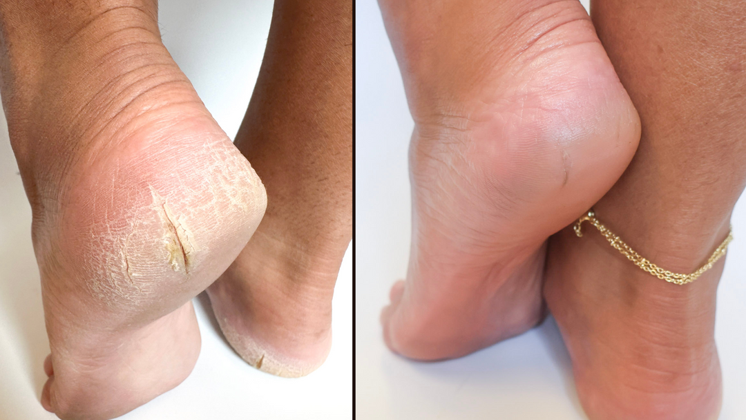 Before and after photos sowing severe dry cracked heels next to an after of the same feet after using the Heel Revival Regimen. The after shows the cracks have been healed and now they have smooth beautiful, hydrated feet.