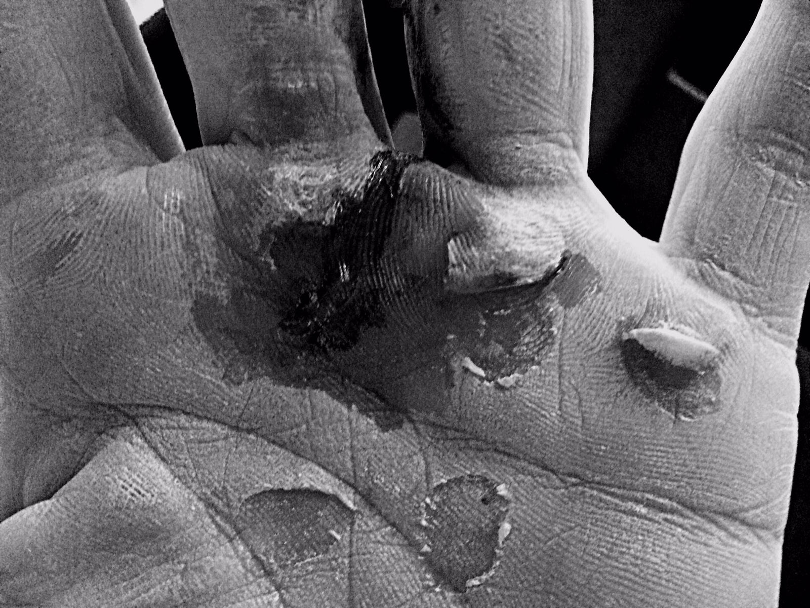 A hand opened up showing the palm that has some deep callus rips with blood