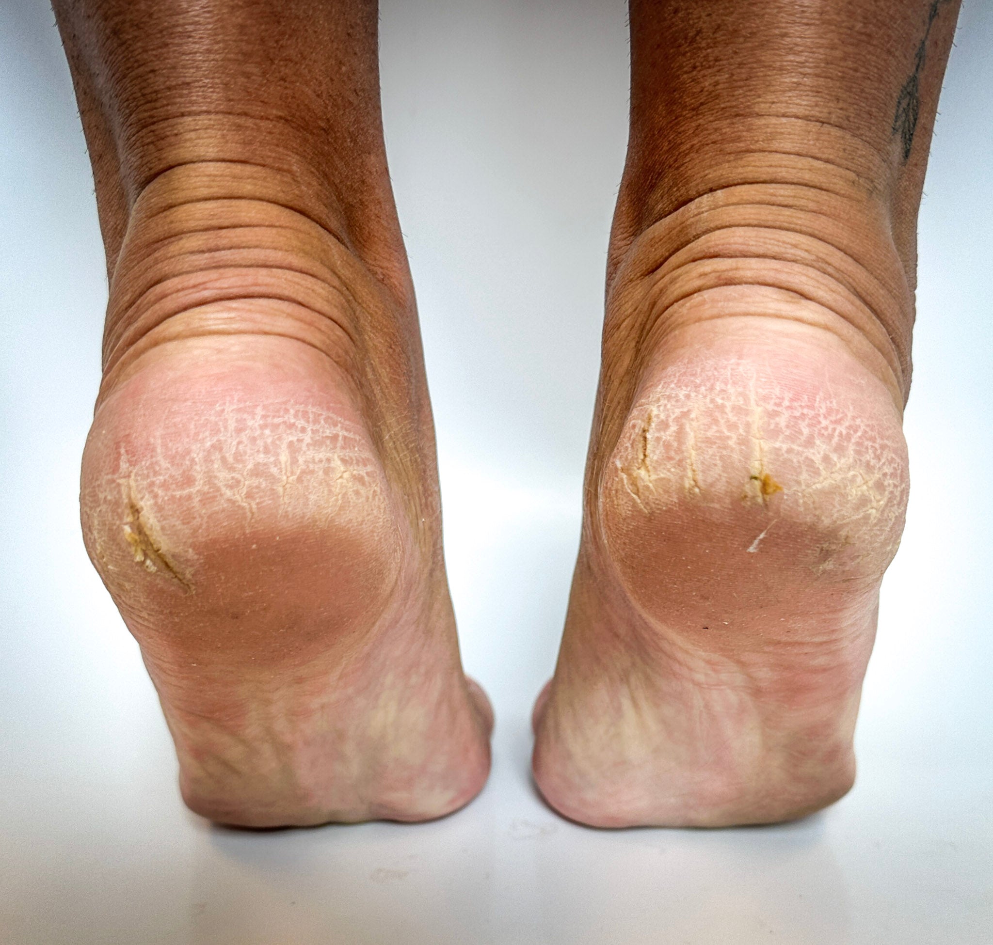 Before: Dirty feet with thick cracked calluses.