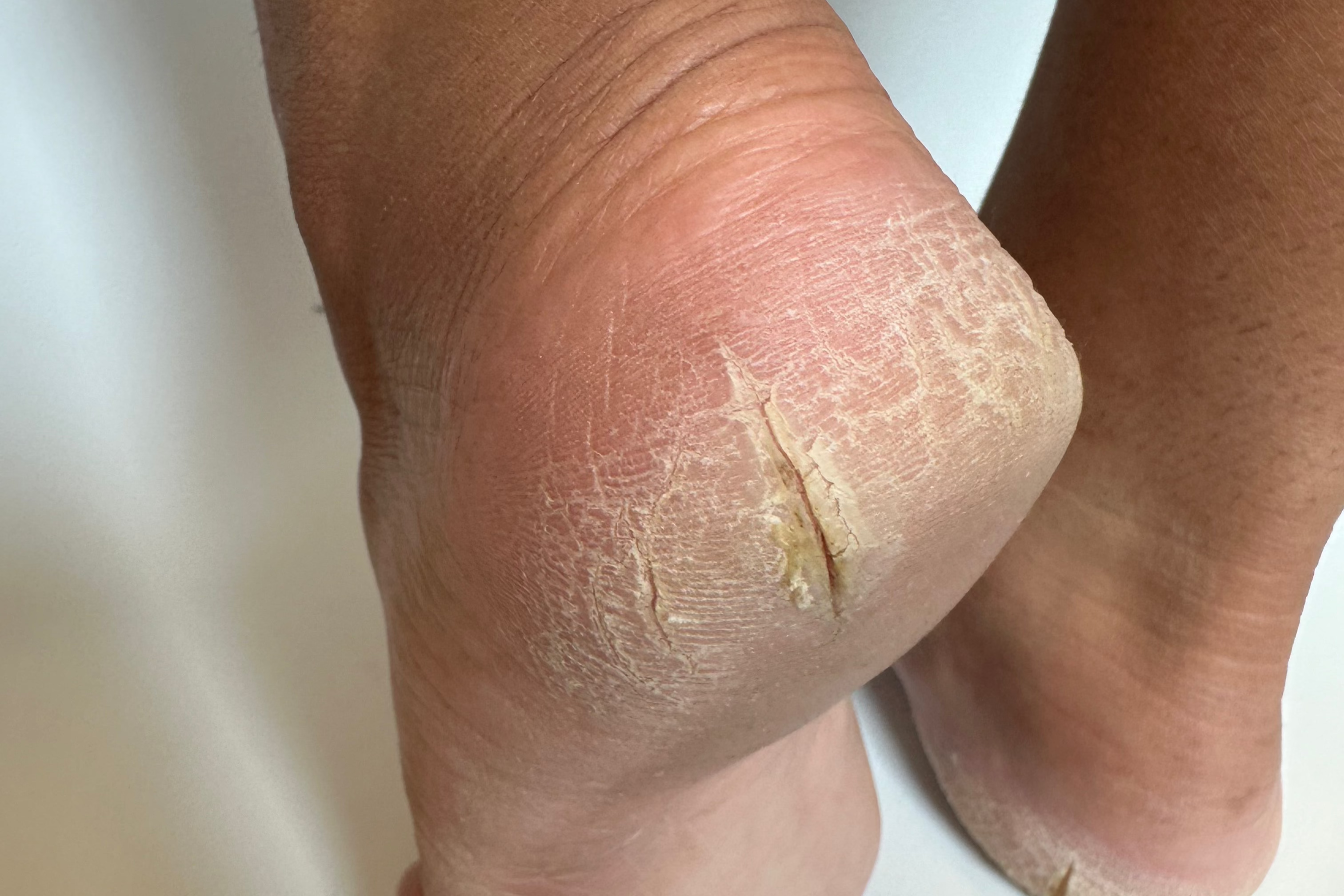 Deep crack on the back of womans heels. Dry thick Callus build up.