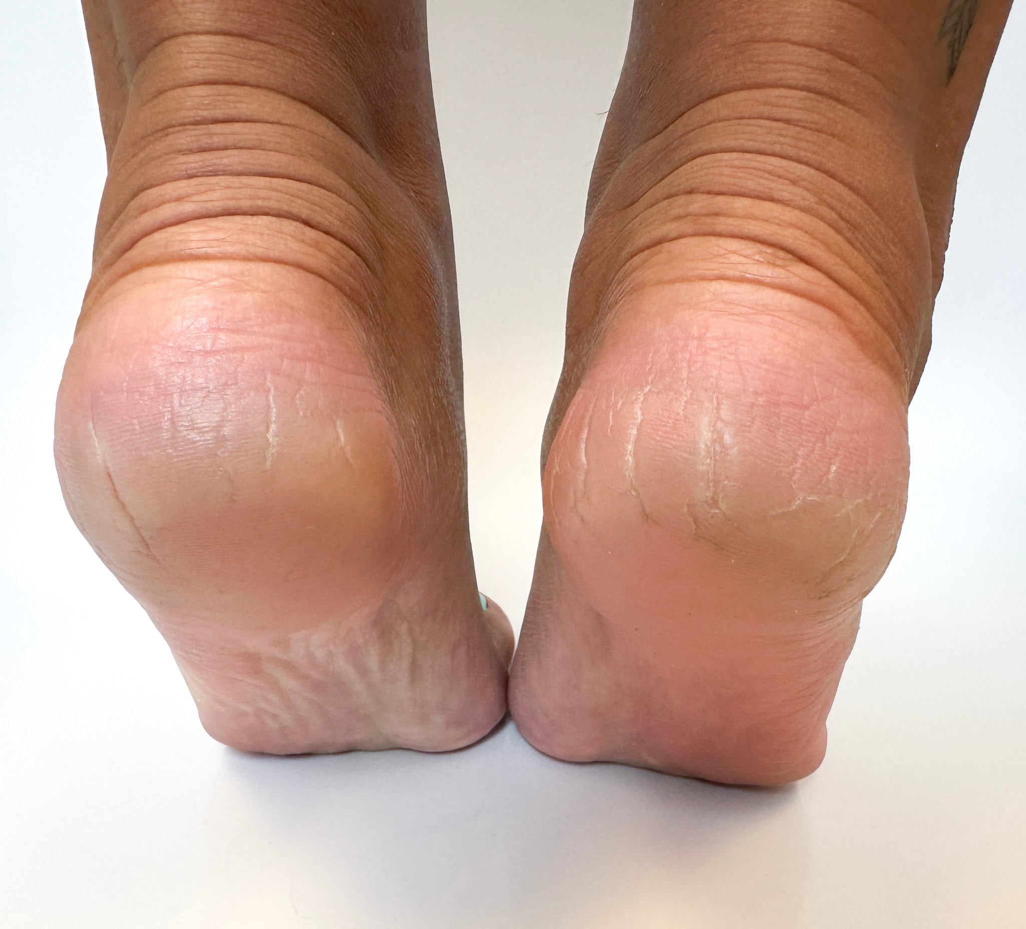 After: Clean feet that have been healed by using the Heel Revival Regimen. Cracked are mostly healed and they are smooth and silky