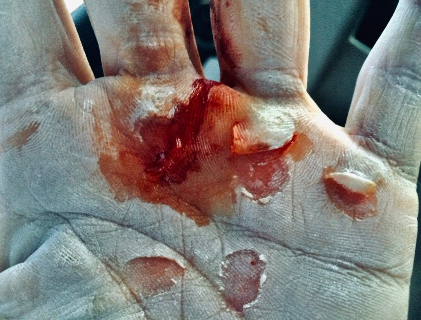 Hand opened up to show bloody deep ripped calluses with also Chalk on the hands.