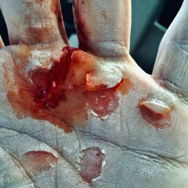 Hand with bloody, deep ripped calluses. Hand is also covered in Chalk