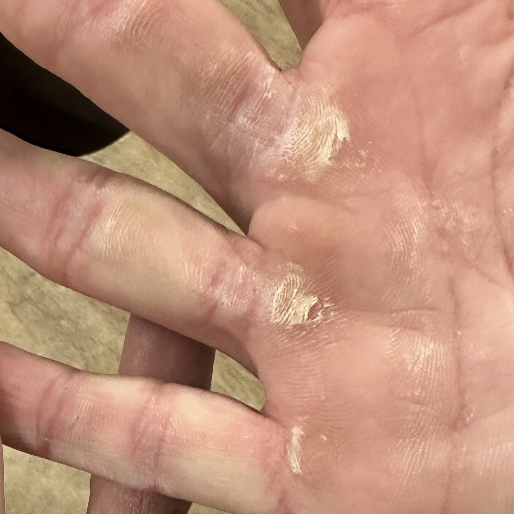 Is Your Yellow Callus Infected? Here'S How To Tell! - 2n66dkw