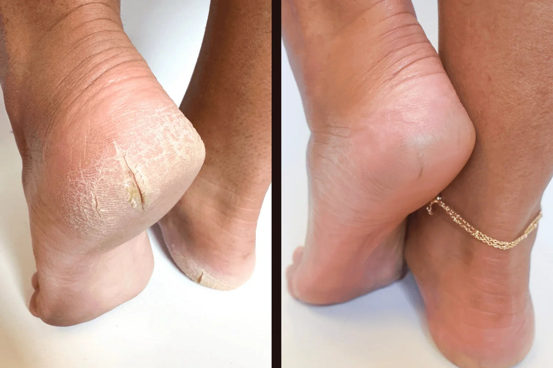 Before-and-after comparison of cracked heels treated with Sandbar Callus Care. 
