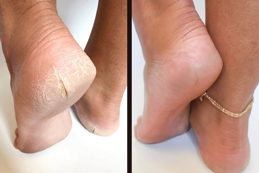 Before-and-after comparison of cracked heels treated with Sandbar Callus Care. 