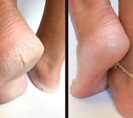 How to Wear Flip-Flops All Summer Without Wrecking Your Heels