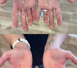 Dry Skin Treatment: Why Your Feet and Hands Need Different Approaches
