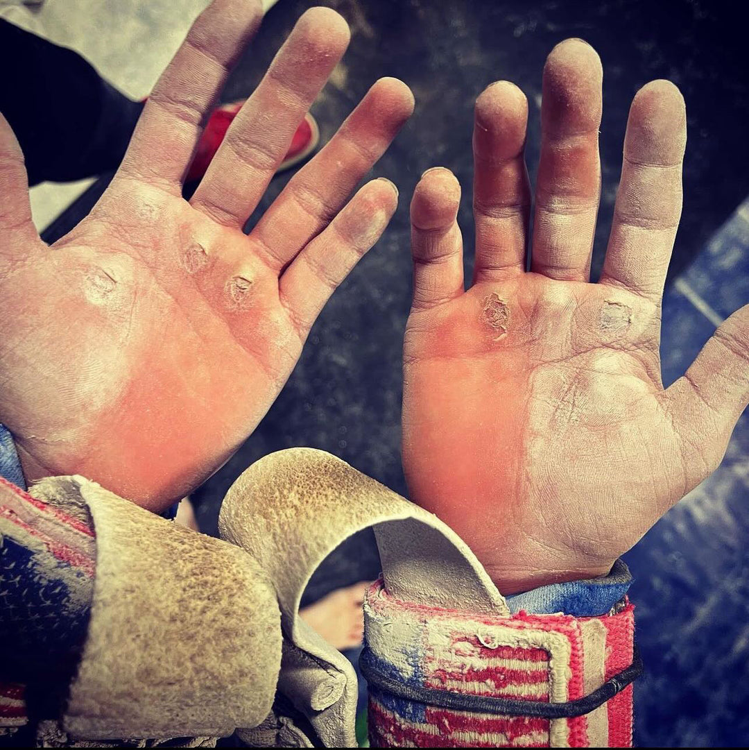 young gymnast hands with thick built-up calluses showing grip wear from uneven bars training