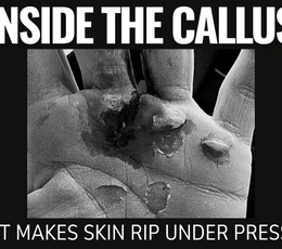 Inside the Callus: What Makes Skin Rip Under Pressure