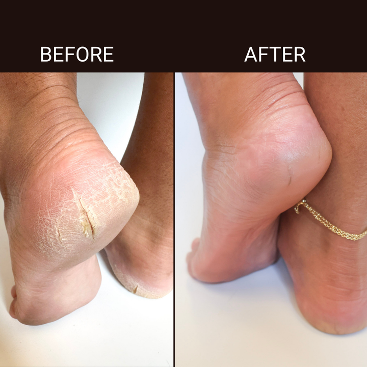 Foot Fungus Heal Dry Cracked Heels Dry Cracked Feet Cracked Heels